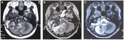 Comprehensive conservative treatment for multiple metastases of skull osteosarcoma: A case report